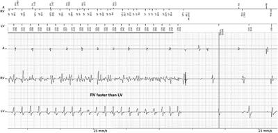 Commentary: Interventricular Differences in Action Potential Duration Restitution Contribute to Dissimilar Ventricular Rhythms in ex vivo Perfused Hearts